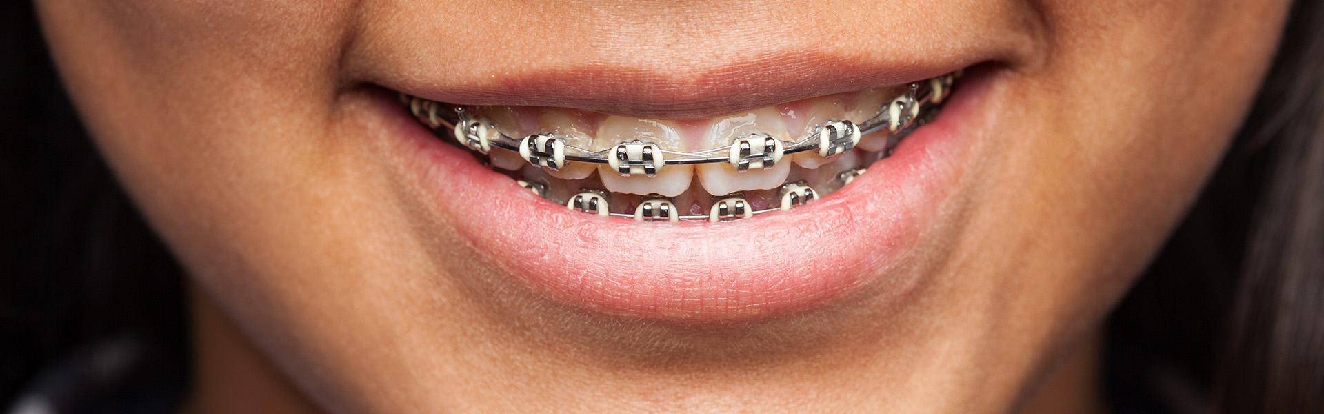 Zähne mit fester Zahnspange